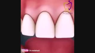 نحوه استفاده صحیح از نخ دندان