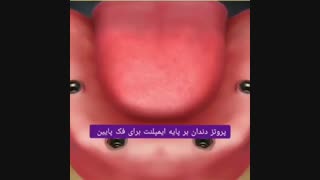 پروتز دندان بر پایه ایمپلنت برای فک پایین