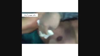 جراحی ژنیکوماستی در یک ورزشکار