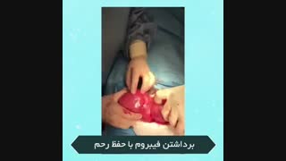 برداشتن فیبروم با حفظ رحم