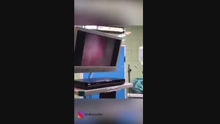 فیلم خارج کردن فیبروم رحم با هیستروسکوپ
