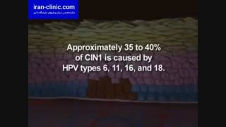 شکل ظاهری و عکس زگیل تناسلی در زنان و مردان در ایران کلینیک