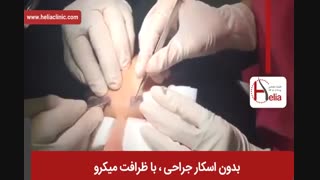 کاشت ابرو | فیلم کاشت ابرو | کلینیک پوست و مو هلیا | شماره 1