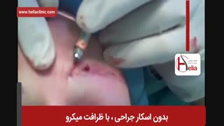 کاشت ابرو | فیلم کاشت ابرو | کلینیک پوست و مو هلیا | شماره 2