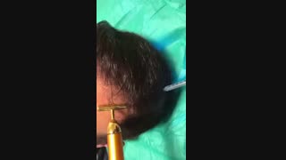 مزوتراپی - 22807060