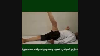 آرتروز شدید زانو و انحراف زانو