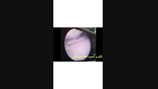 ترمیم منیسک داخلی و بازسازی رباط صلیبی با روش بسته آرتروسکوپی