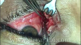 جراحی خروج سوزن فرورفته در کاسه چشم