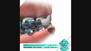 اورژانس های ارتودنسی | دکتر لادن طیبی