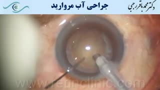 فیلم عمل آب مروارید