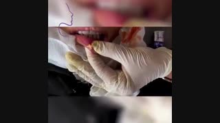 تخلیه ژل لب