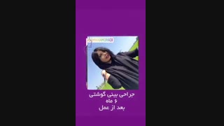 نمونه کار جراحی زیبایی بینی