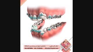 ارتودنسی با کشیدن دندان | دکتر طیبی