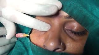 تزریق چربی به زیر چشم با روش نانوفت