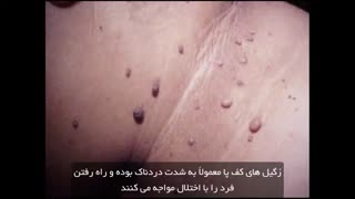 زگیل چیست و انواع آن /زگیل تناسلی در زنان و مردان (https://hpvdarman.com/)