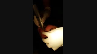 برداشتن خال - 22807060