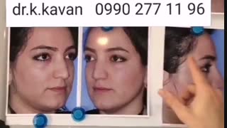 جراحی زیبایی بینی توسط دکتر کاوان