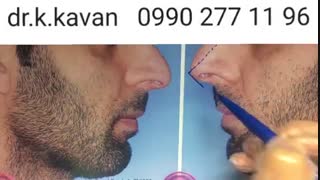 جراحی بینی استخوانی و گوشتی توسط دکتر کاوان