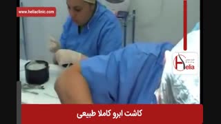 کاشت ابرو | فیلم کاشت ابرو | کلینیک پوست و مو هلیا | شماره 5