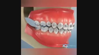 فیلم درمان ناهنجاری دندانی دیپ بایت