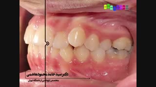 فیلم قبل و بعد از ارتودنسی