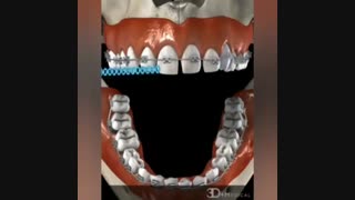 فیلم ازبین بردن فاصله دندان ها با ارتودنسی