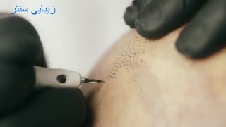 میکرو اسکالپ سر یا هاشور کف سر،میکروپیگمنتیشن سر,زیبایی سنتر