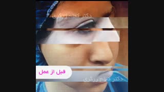 رضایت بیمار بعد از جراحی بینی
