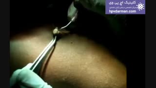 درمان قطعی زگیل تناسلی با لیزر در کلینیک اچ پی وی https://hpvdarman.com/