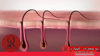 لیزر موهای زائد | لیزر مو | کلینیک پوست و مو رز | شماره 17