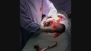 زایمان سزارین
