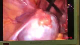 لاپاراسکوپی کیست تخمدان و بستن لوله های رحمی