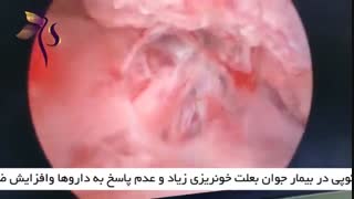 هیستروسکوپی در بیمار جوان