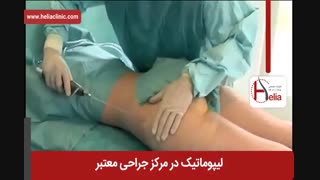 لیپوماتیک | فیلم لیپوماتیک | کلینیک پوست و مو هلیا | شماره 8