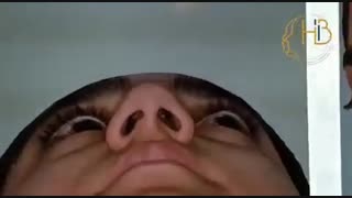 نمونه جراحی بینی دکتر هیربد بهنام