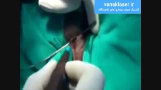 مزایای درمان فیستول مقعدی با لیزر در ونک لیزر