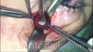 جراحی توده کیستیک عصب بینایی