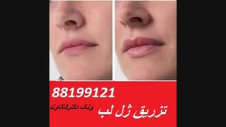 لیزر بوتاکس و زیبایی نگار