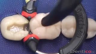 کامپوزیت3M ESPE Bulk Fill Posterior