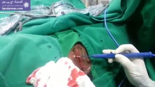 زگیل تناسلی در زنان/علائم نشانه ها و درمان در:  کلینیک اچ پی وی