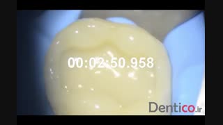 کامپوزیت GC GRADIA DIRECT Posterior