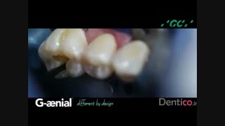 کامپوزیت GC G- aenial posterior