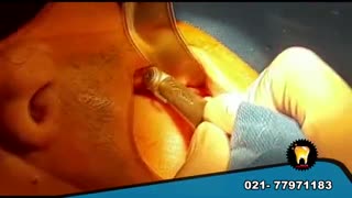 جراحی کاشت ایمپلنت دندان در دندانپزشکی معتبر تهران