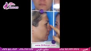 عمل زیبایی بینی و پلک توسط دکتر کاوان