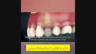ترمیم شکستگی دندان با روکش های زیبایی