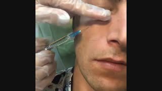 تزریق فیلر زیر چشم جوانسازی پوست