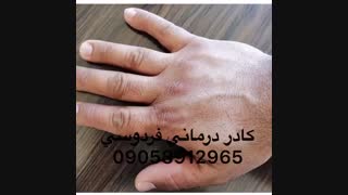 کسانی که اگزما دارید حتما این ویدئو رو ببینید و شگفت زده شوید