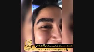 تجربه کاشت ابرو