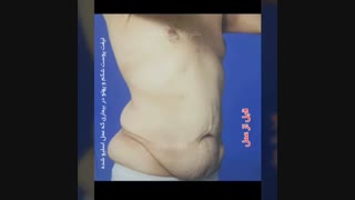 لیفت شکم و پهلو در بیماری که عمل اسلیو شده دکتر سلیمان زاده