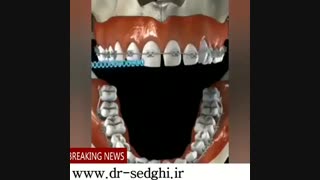 از بین بردن فاصله دندان ها با ارتودنسی